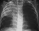 Pneumonia x-ray