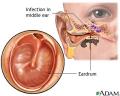 Ear Infections child
